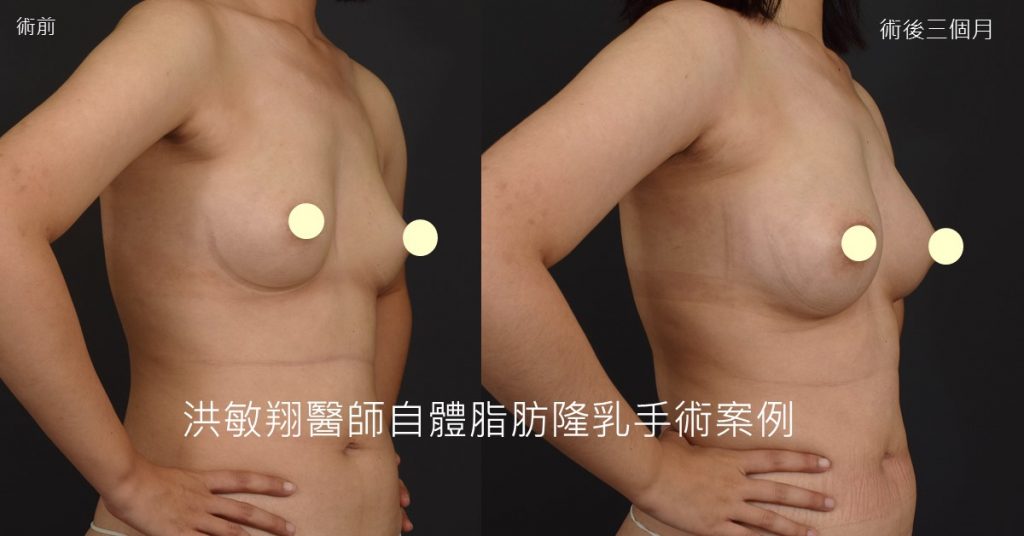 洪敏翔整形外科醫師-自體脂肪移植案例