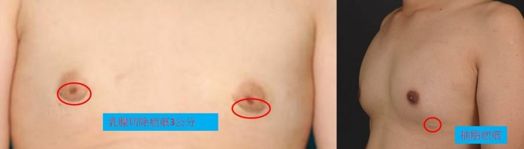 傳統複合式男性女乳手術會在胸前留下疤痕且乳暈切除乳腺傷口較明顯