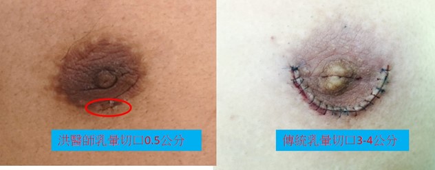 洪醫師乳腺切除傷口僅需0.5-1.0公分