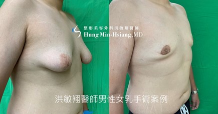 洪醫師採用引痕式提乳手術搭配抽脂及乳腺切除,改善嚴重下垂型男性女乳症,且外觀幾乎無疤,大大提升患者手術意願。