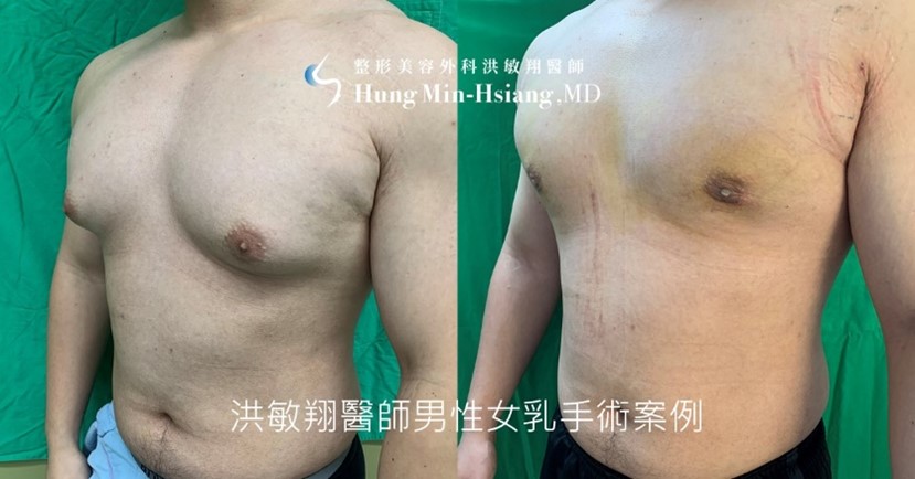 洪醫師採用超微創複合式男性女乳手術,透過僅約1公分左右傷口,徹底改善女乳問題。