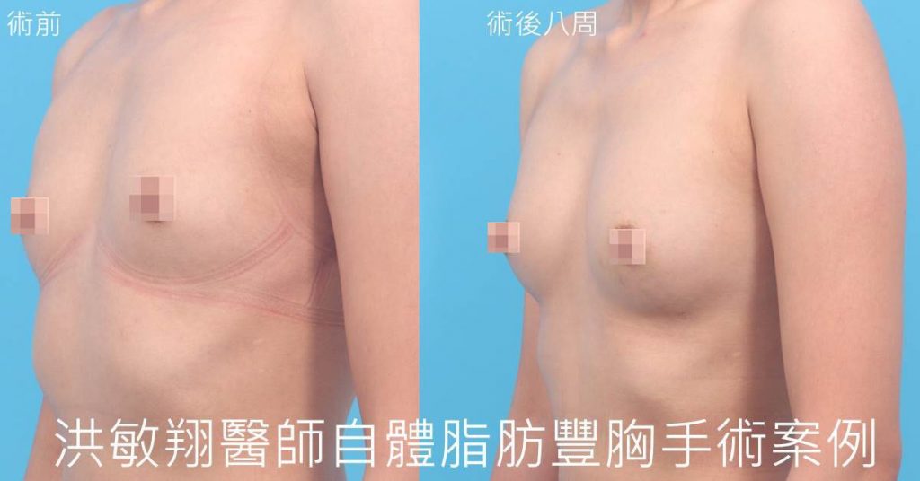 洪敏翔整形外科醫師-自體脂肪移植案例