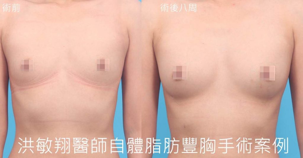 洪敏翔整形外科醫師-自體脂肪移植案例