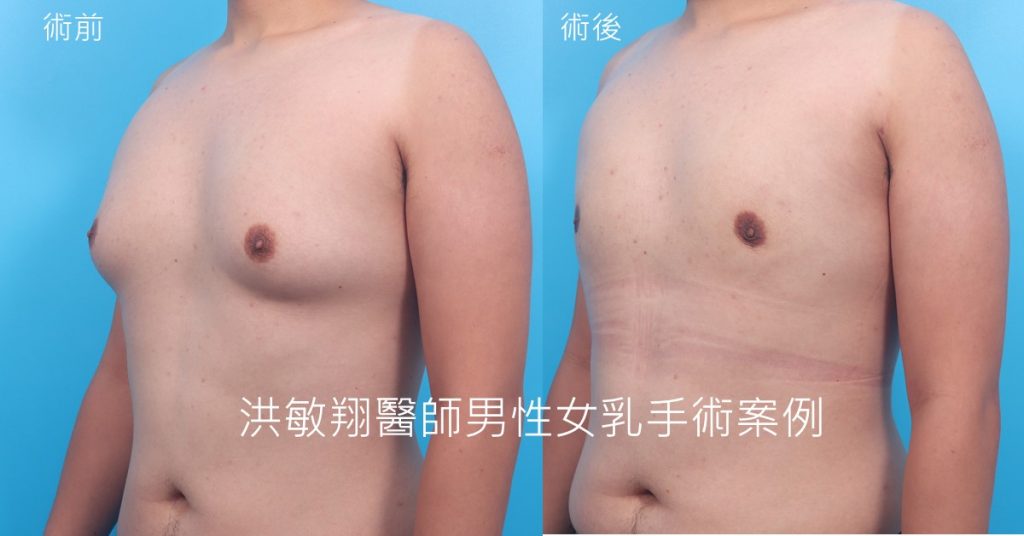 洪敏翔整形外科醫師-男性女乳症案例