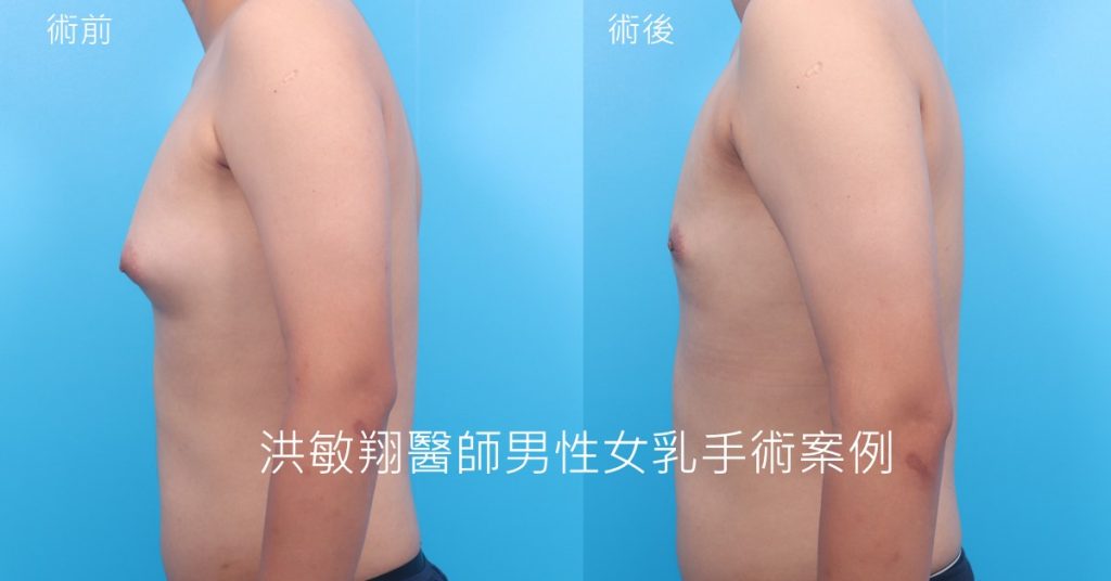 洪敏翔整形外科醫師-男性女乳症案例