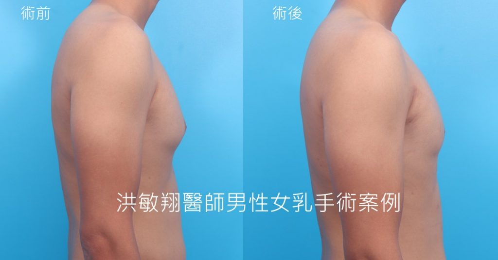 洪敏翔整形外科醫師-男性女乳症案例