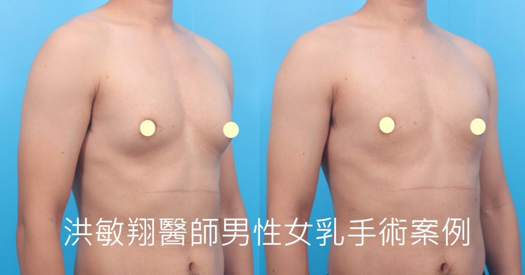 洪敏翔整形外科醫師-男性女乳症案例