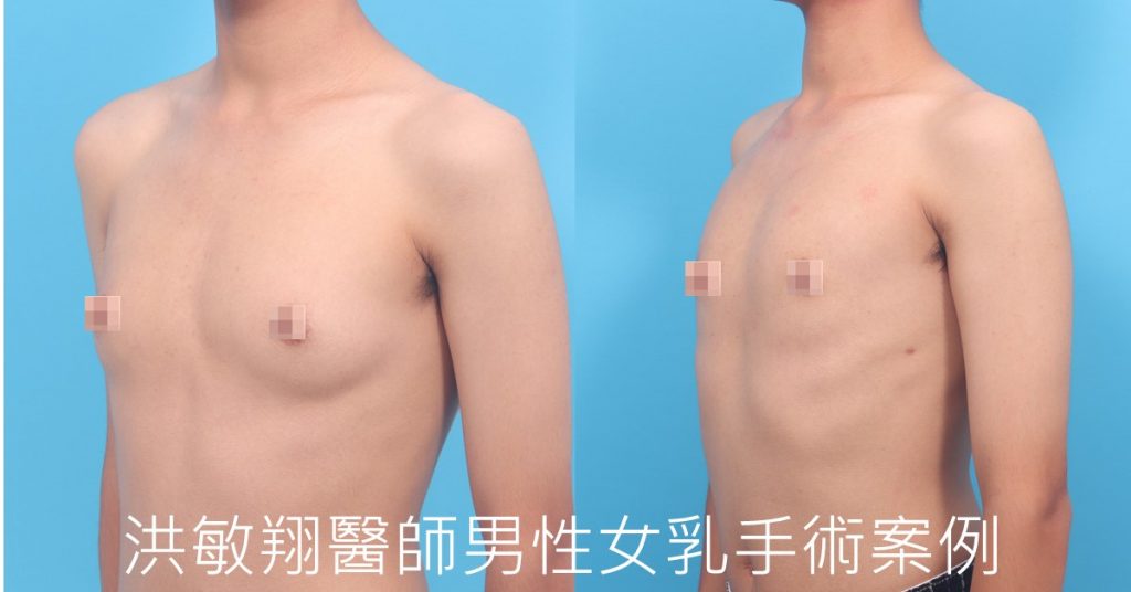 洪敏翔整形外科醫師-男性女乳症案例