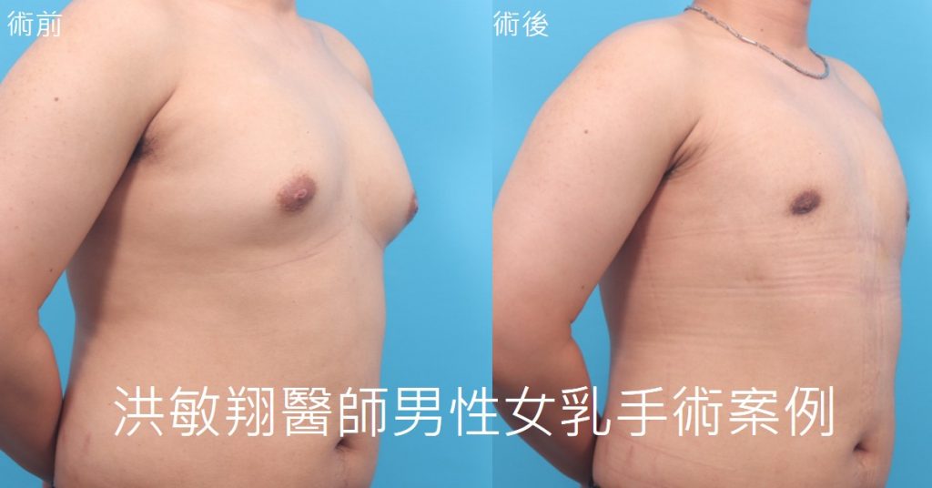 洪敏翔整形外科醫師-男性女乳症案例