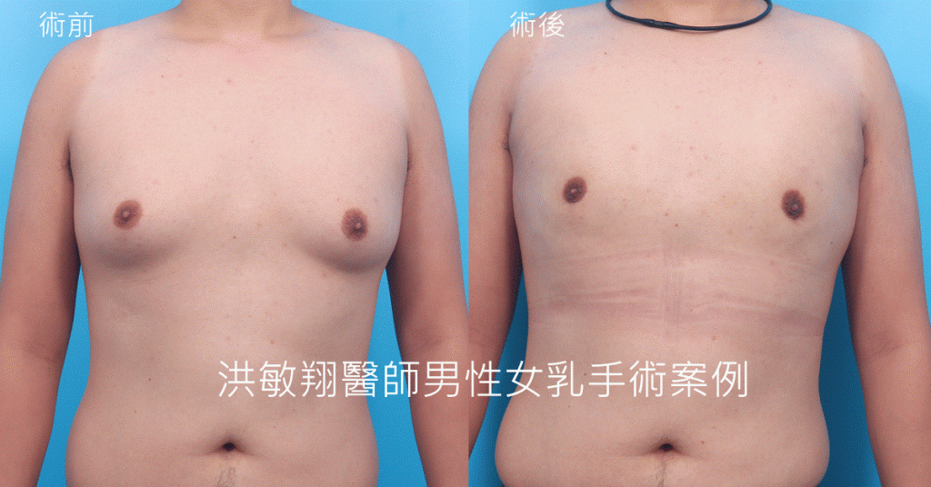 洪敏翔整形外科醫師-男性女乳症案例