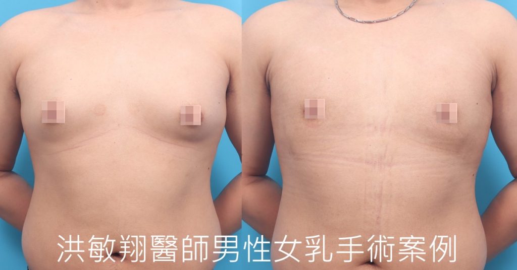 洪敏翔整形外科醫師-男性女乳症案例