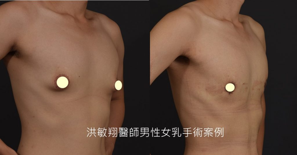 洪敏翔整形外科醫師-男性女乳症案例