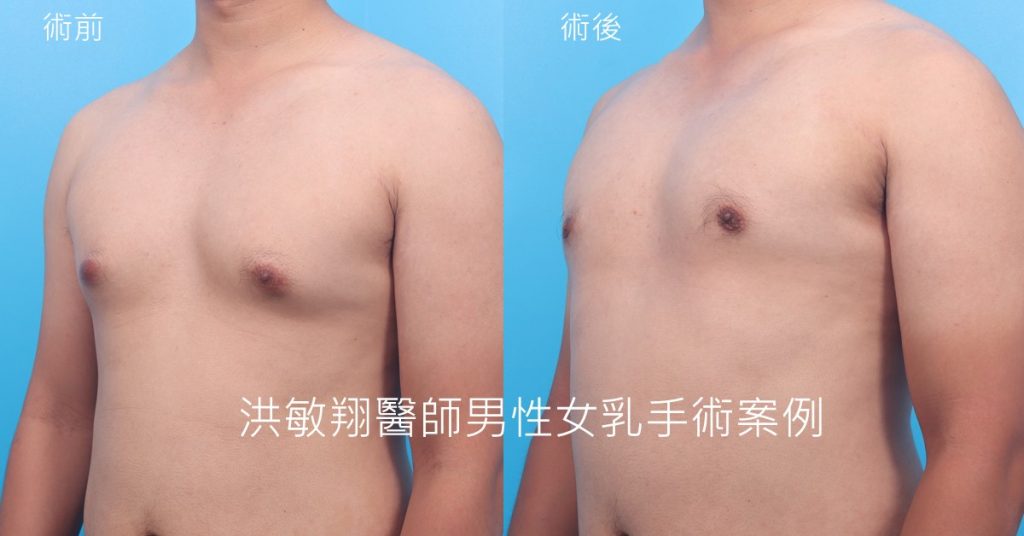 洪敏翔整形外科醫師-男性女乳症案例