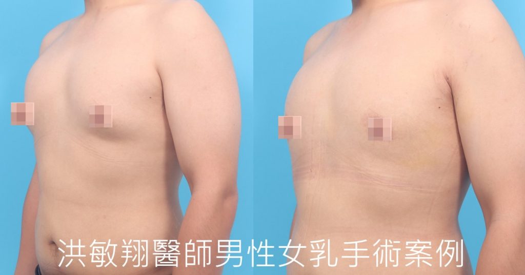 洪敏翔整形外科醫師-男性女乳症案例