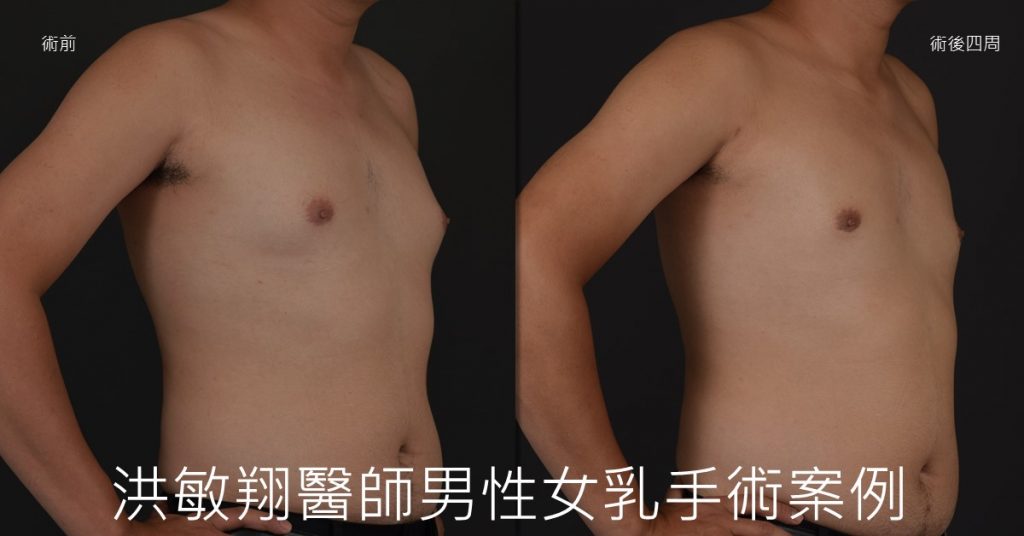 洪敏翔整形外科醫師-男性女乳症案例