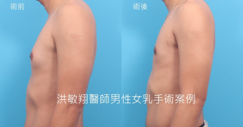 洪敏翔整形外科醫師-男性女乳症案例