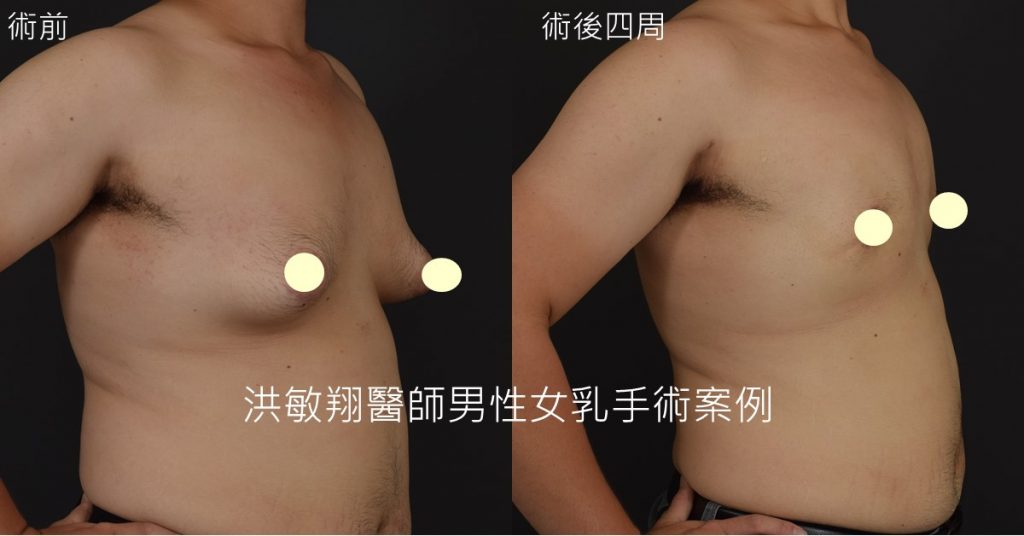 洪敏翔整形外科醫師-男性女乳症案例