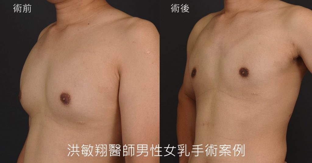 洪敏翔整形外科醫師-男性女乳症案例