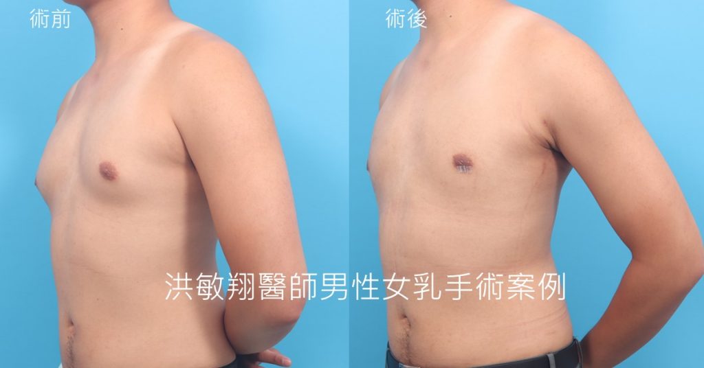 洪敏翔整形外科醫師-男性女乳症案例