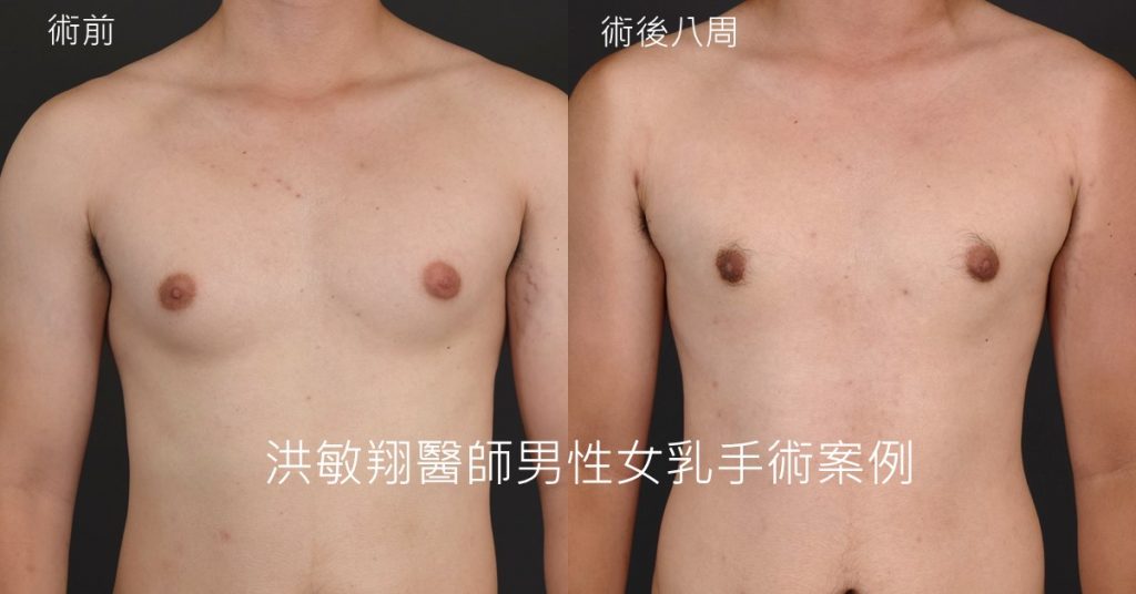 洪敏翔整形外科醫師-男性女乳症案例