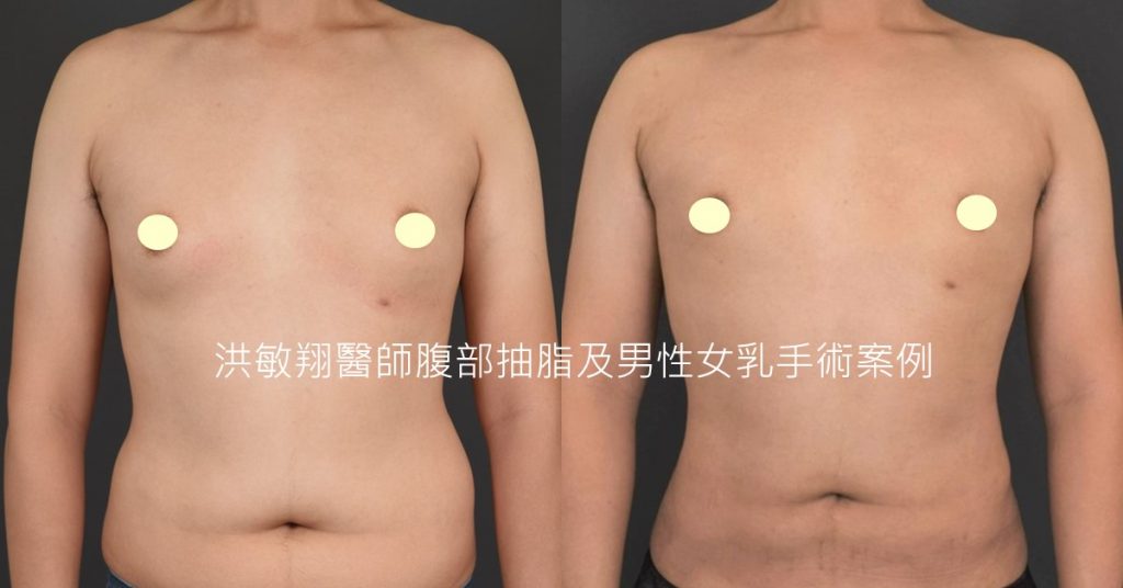 洪敏翔整形外科醫師-男性女乳症案例