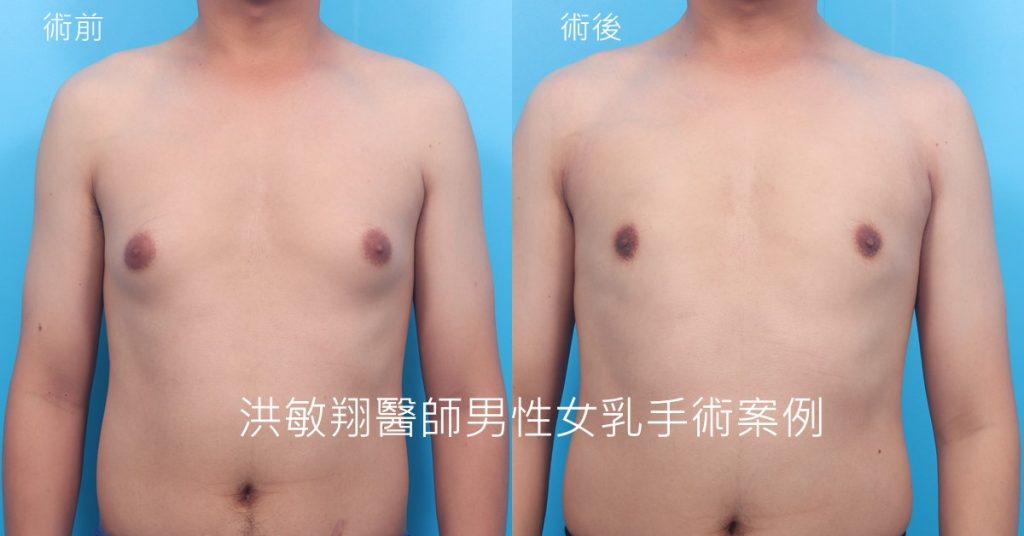 洪敏翔整形外科醫師-男性女乳症案例