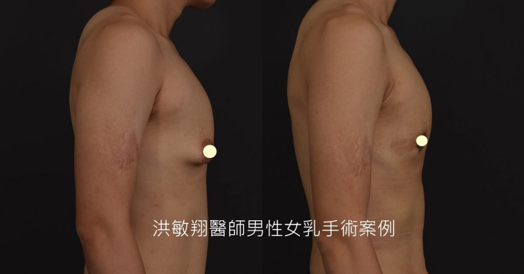 洪敏翔整形外科醫師-男性女乳症案例