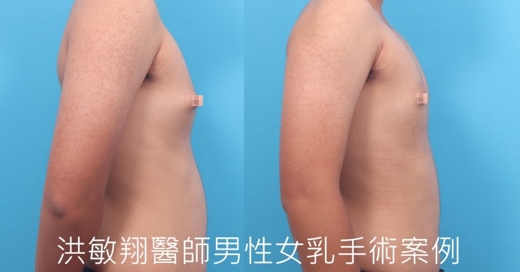 洪敏翔整形外科醫師-男性女乳症案例