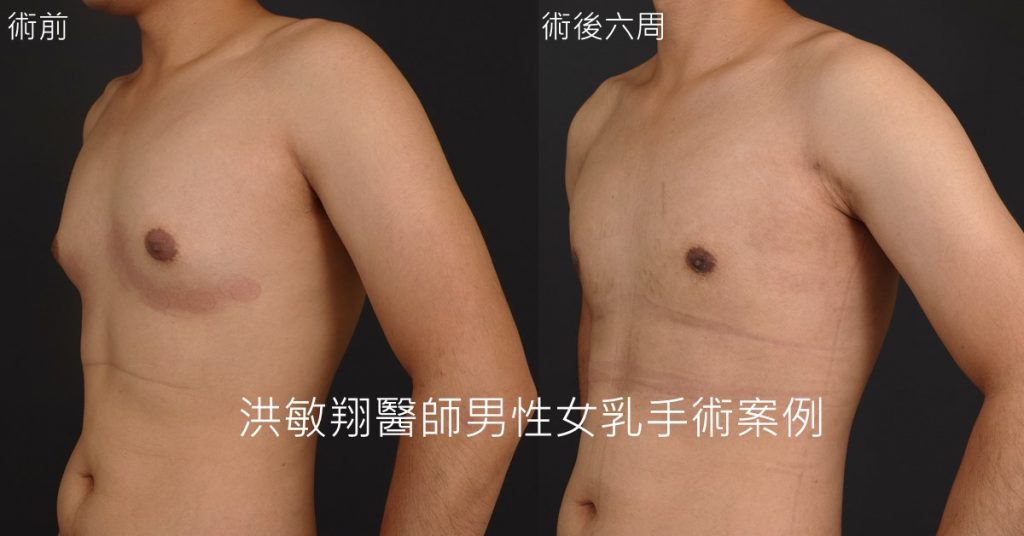 洪敏翔整形外科醫師-男性女乳症案例