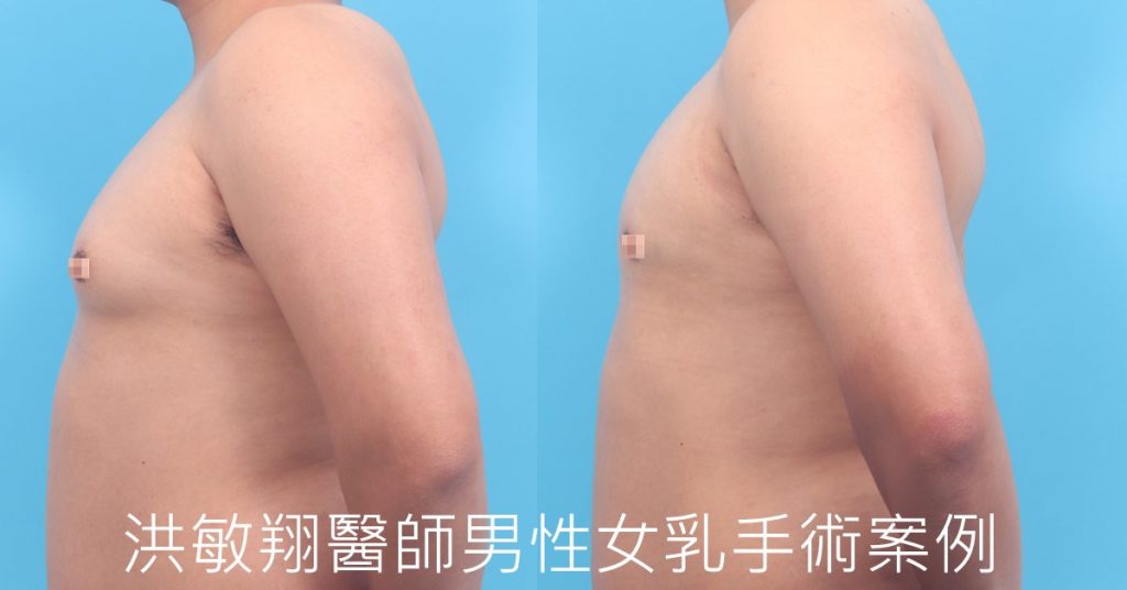 洪敏翔整形外科醫師-男性女乳症案例