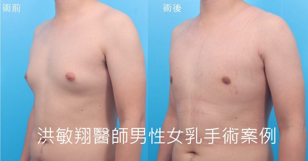 洪敏翔整形外科醫師-男性女乳症案例