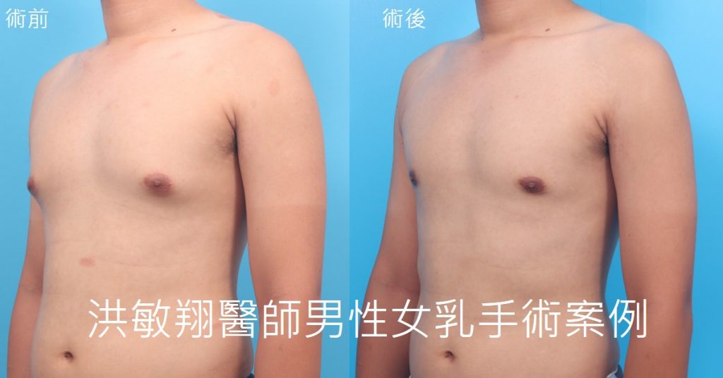 洪敏翔整形外科醫師-男性女乳症案例