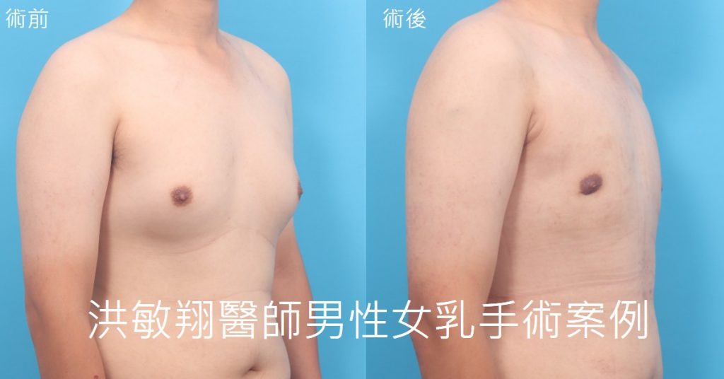 洪敏翔整形外科醫師-男性女乳症案例