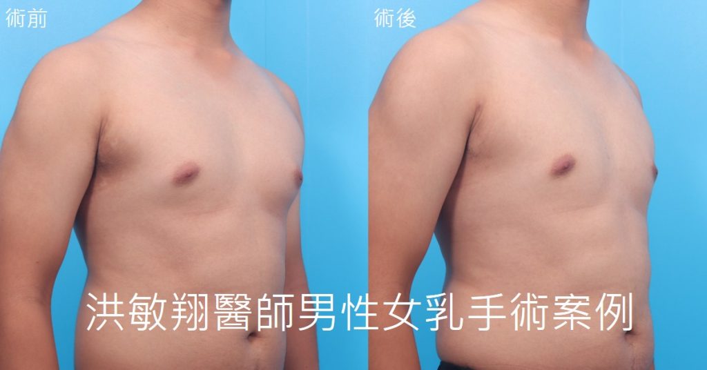 洪敏翔整形外科醫師-男性女乳症案例