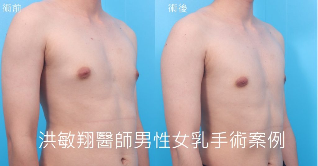 洪敏翔整形外科醫師-男性女乳症案例