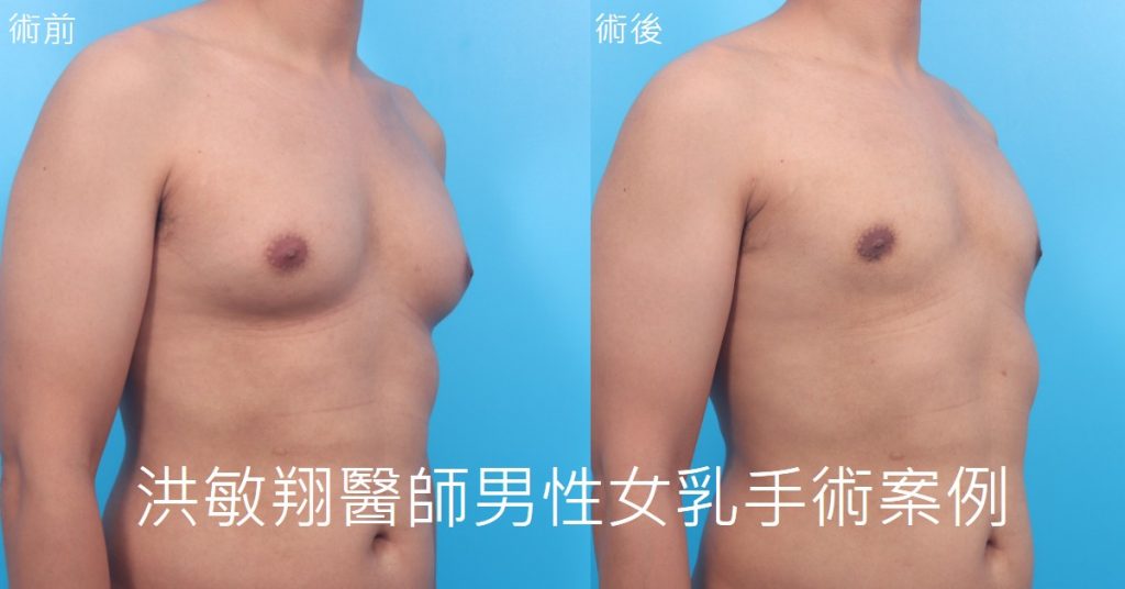 洪敏翔整形外科醫師-男性女乳症案例