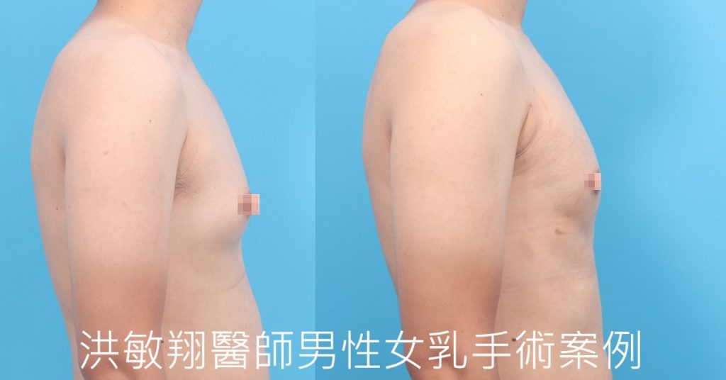 洪敏翔整形外科醫師-男性女乳症案例