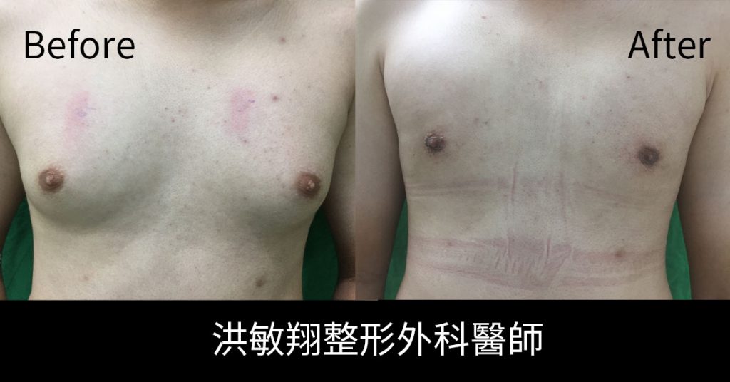 洪敏翔整形外科醫師-男性女乳症案例