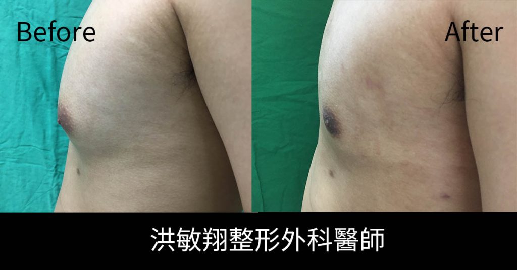 洪敏翔整形外科醫師-男性女乳症案例