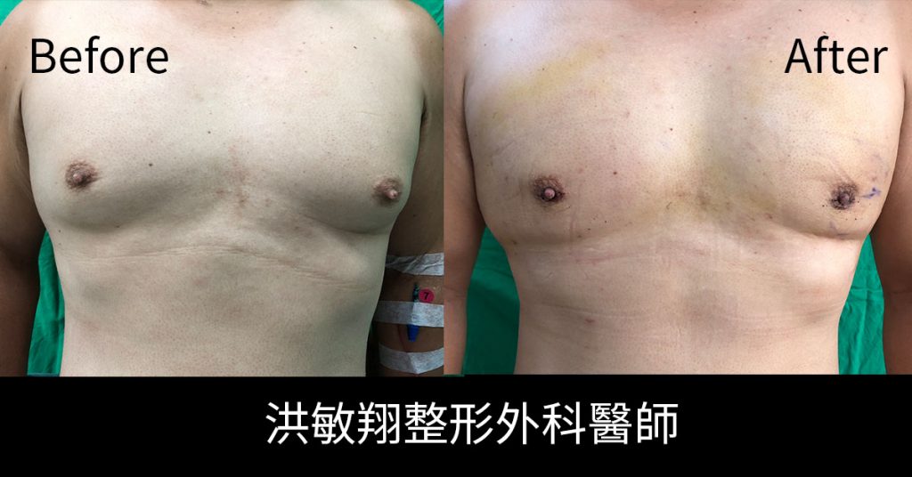 洪敏翔整形外科醫師-男性女乳症案例