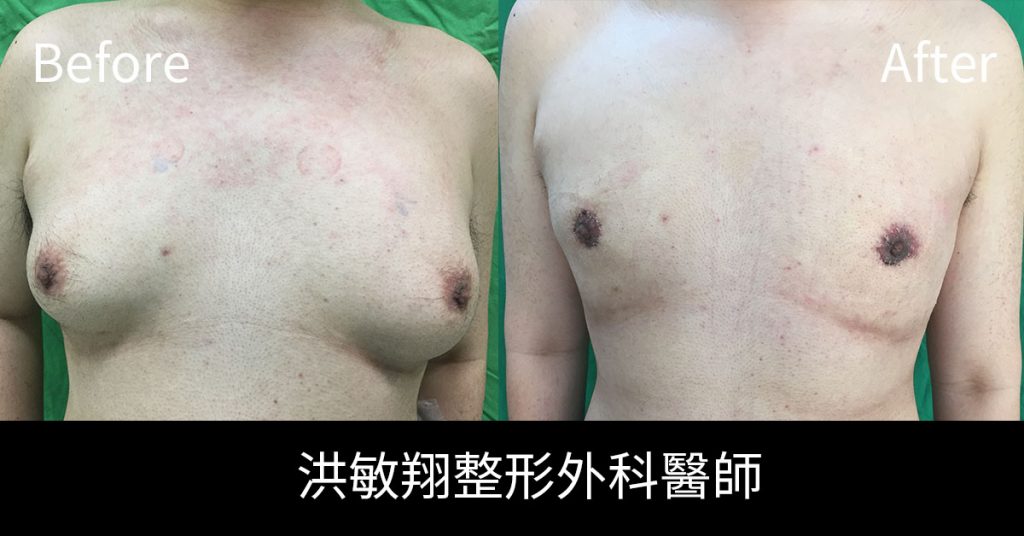 洪敏翔整形外科醫師-男性女乳症案例