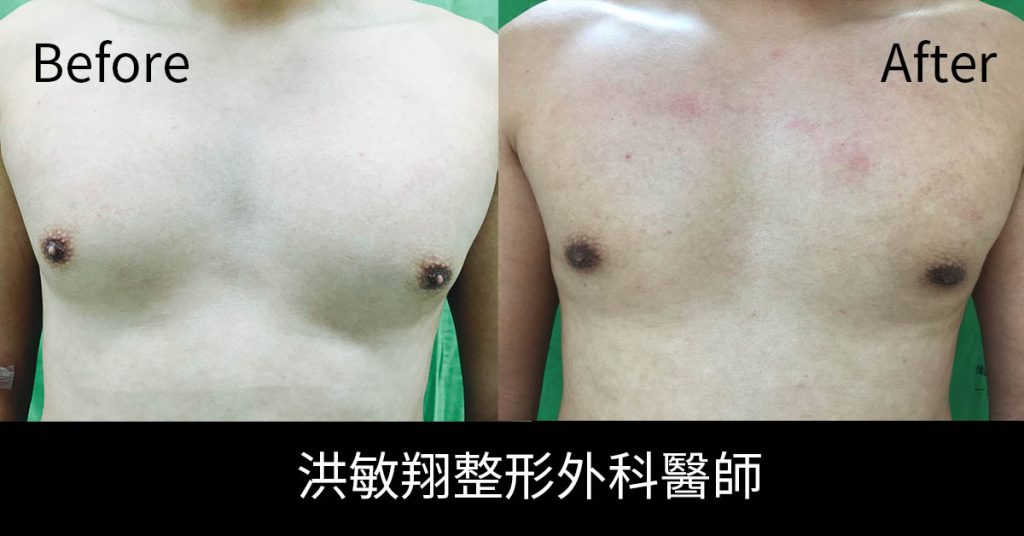 洪敏翔整形外科醫師-男性女乳症案例