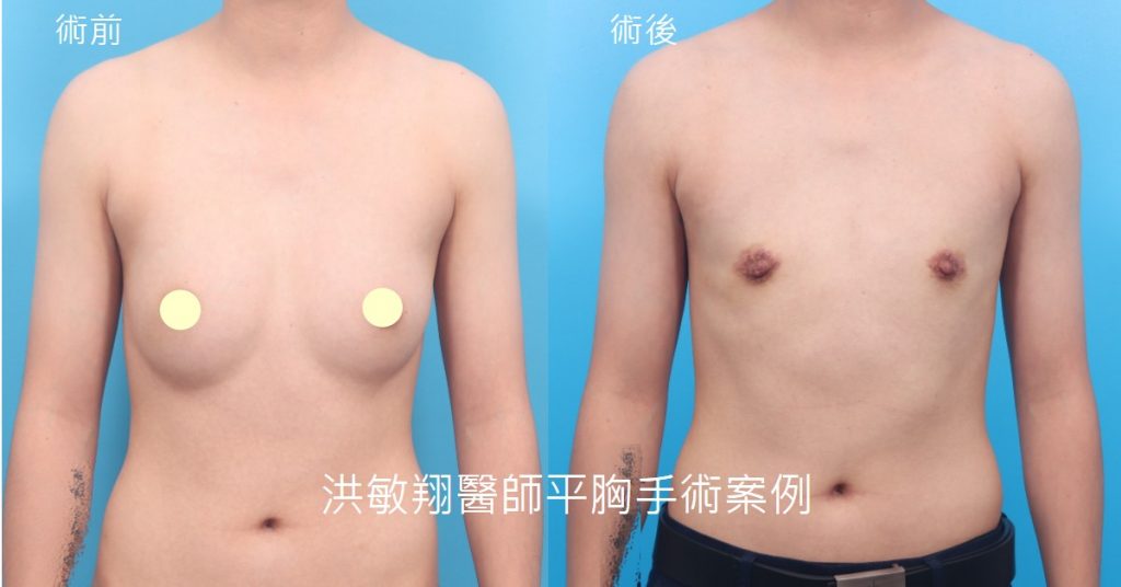 洪敏翔整形外科醫師-平胸手術案例