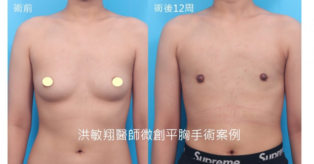 洪敏翔整形外科醫師-平胸手術案例