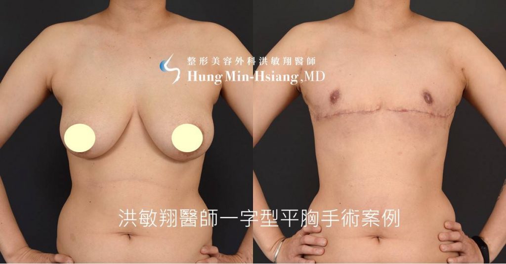 洪敏翔整形外科醫師-平胸手術案例