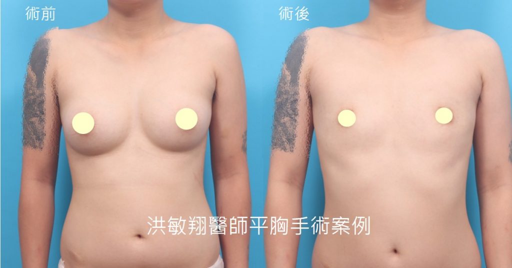 洪敏翔整形外科醫師-平胸手術案例