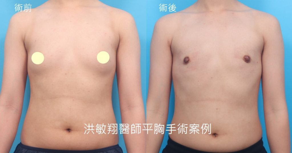 洪敏翔整形外科醫師-平胸手術案例