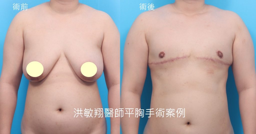 洪敏翔整形外科醫師-平胸手術案例