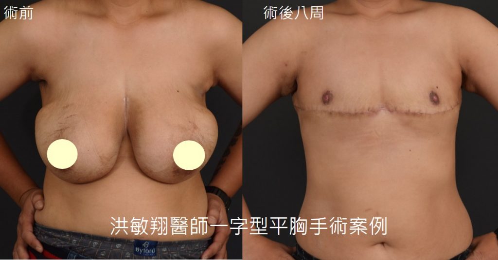 洪敏翔整形外科醫師-平胸手術案例