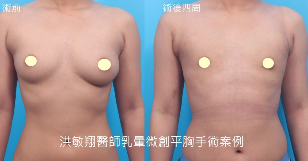 洪敏翔整形外科醫師-平胸手術案例